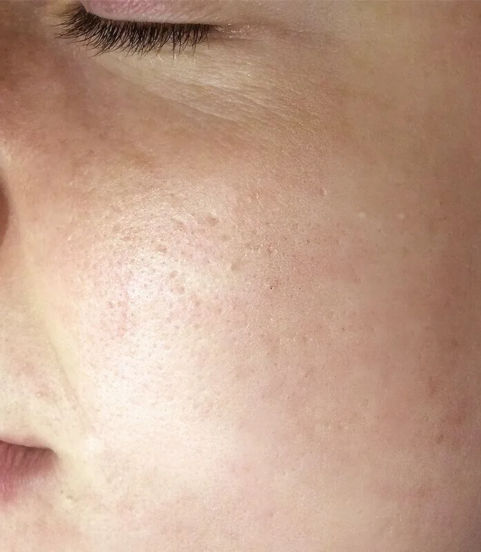 SkinNeedling_Cheek_After-1