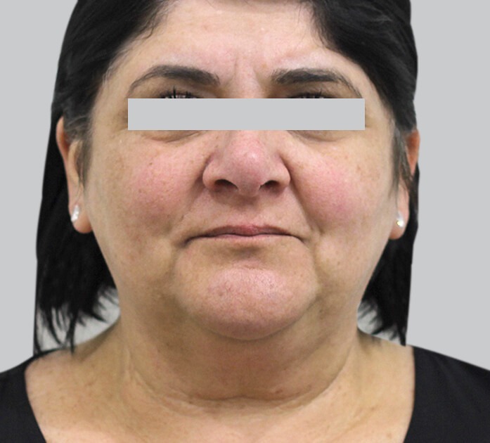 Double Chin Removal, Injections & Treatment | Australian Laser & Skin ...