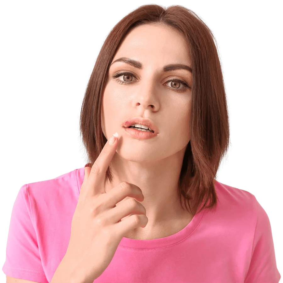 Cold Sores