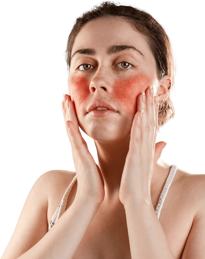 Rosacea