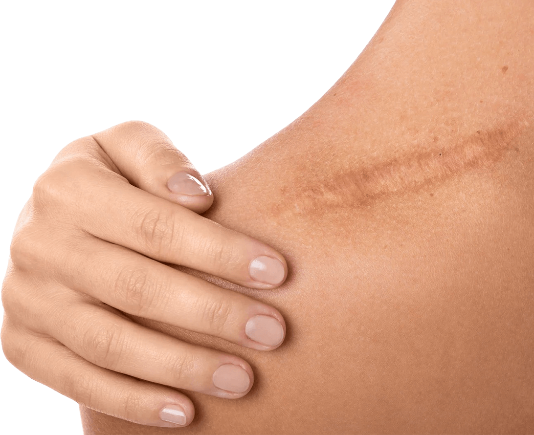 Scarring And Stretch Marks