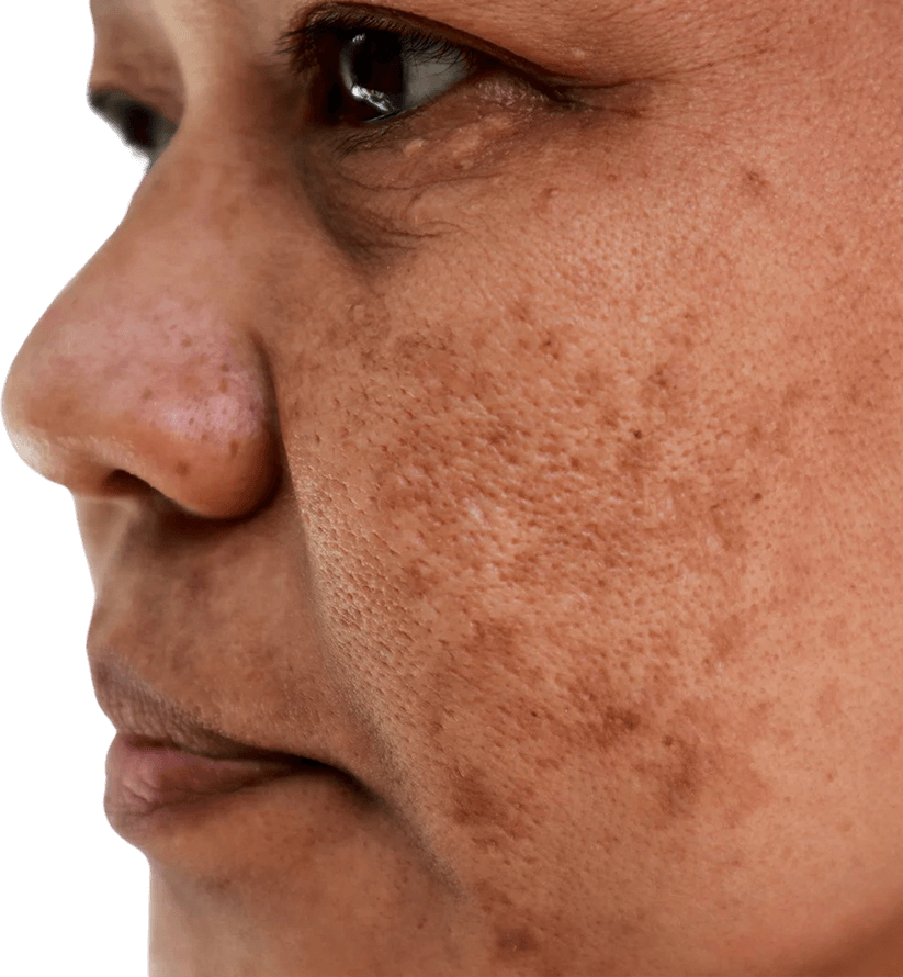 Uneven Skin Tone