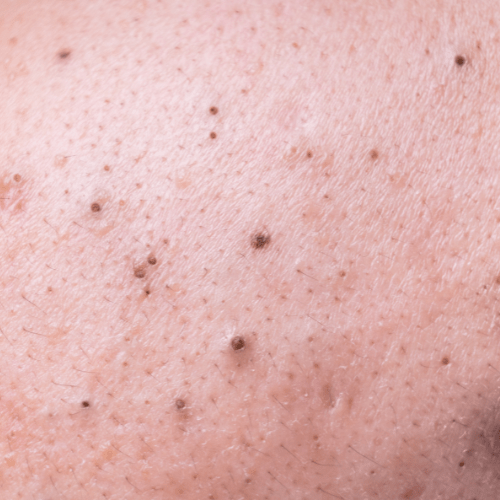 Blackheads / Whiteheads