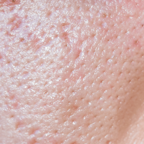 Enlarged Pores