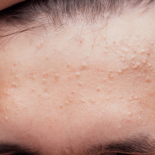 Sebaceous Hyperplasia