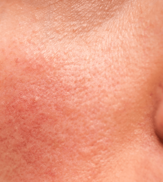 Rosacea