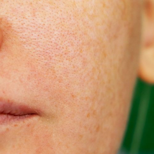 Pigmentation