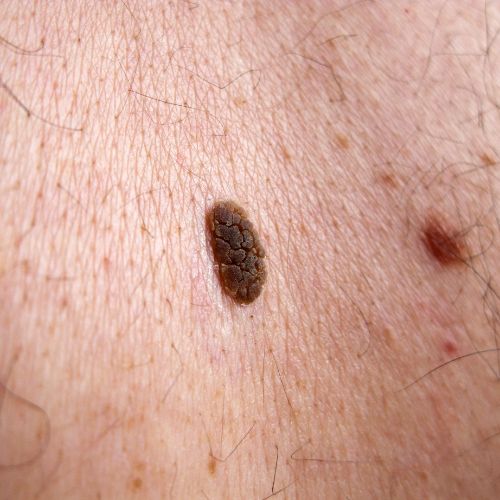 Seborrhoeic Keratoses