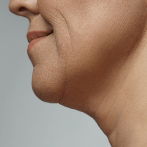 Neck Ageing