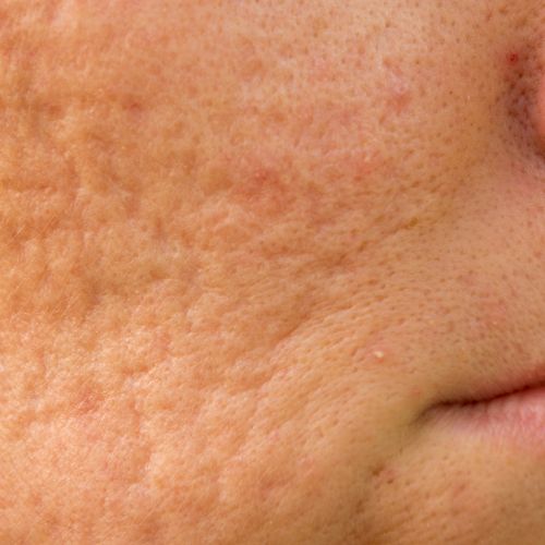 Acne Scars