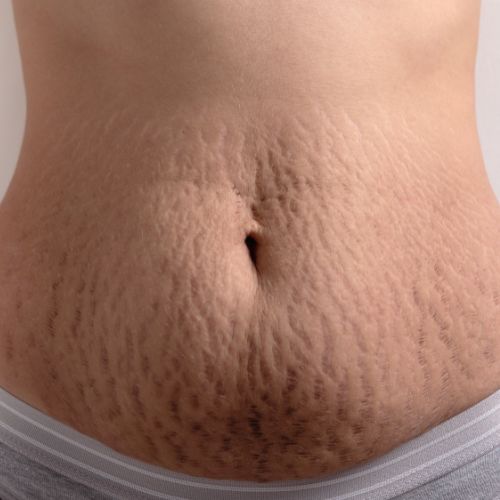 Stretch Marks