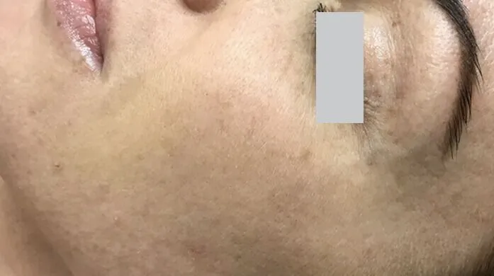 SkinNeedling_Side_After