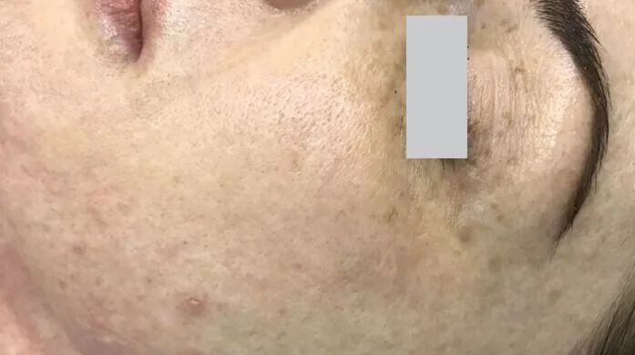 SkinNeedling_Side_Before