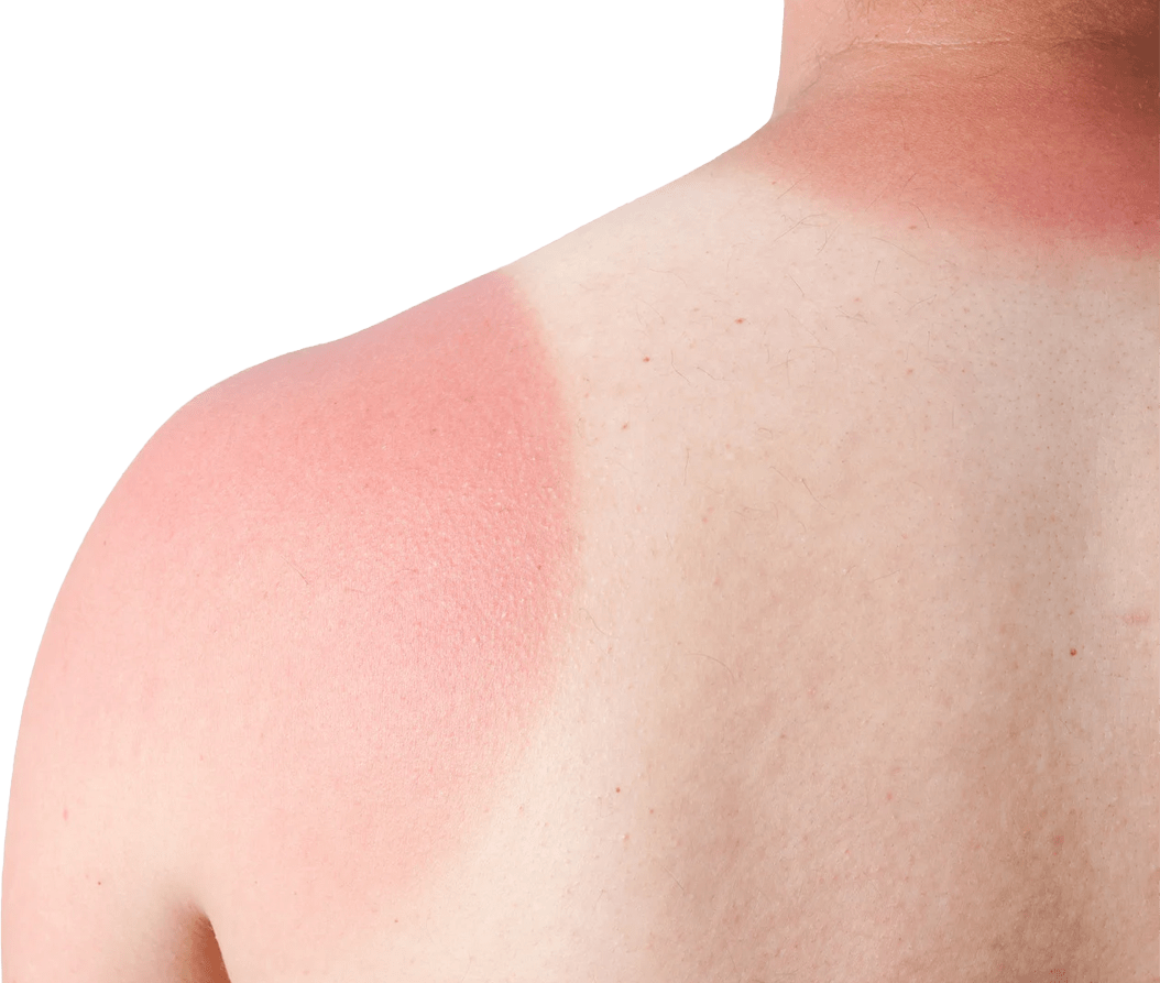 Sun Damage