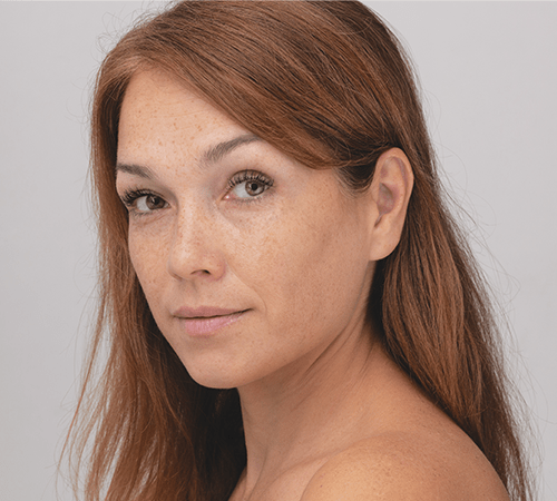 Skin Concern Pigmentation