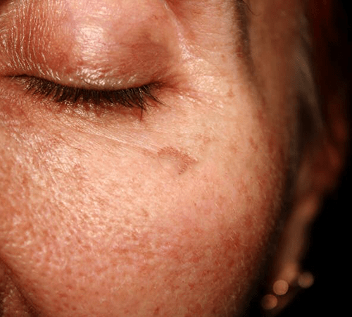 Skin Concern Sun Damage