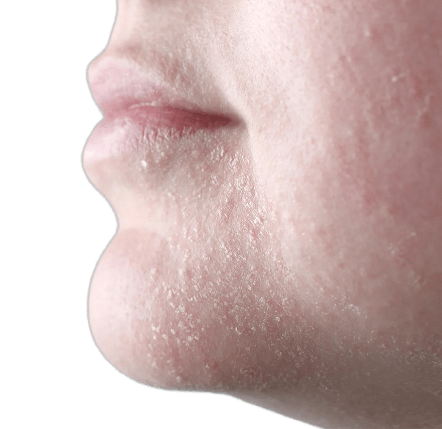 Dehydrated Skin Dehydrated Skin