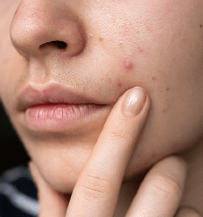 Common Causes of Acne and Blemishes