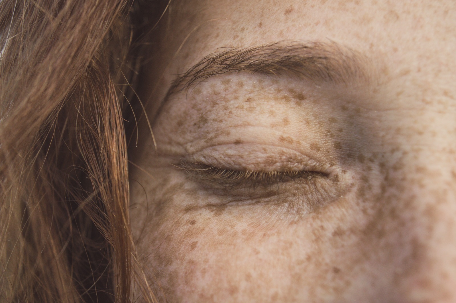 Freckles